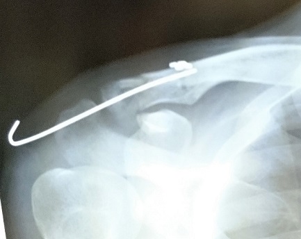 骨幹骨折のレントゲン写真